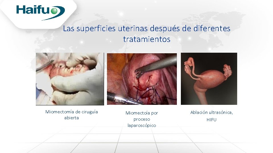 Las superficies uterinas después de diferentes tratamientos Miomectomía de ciruguía abierta Miomectoía por proceso