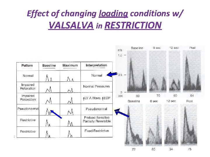 Effect of changing loading conditions w/ VALSALVA in RESTRICTION E 20% A to a