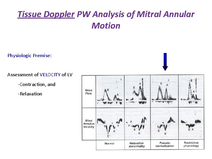 Tissue Doppler PW Analysis of Mitral Annular Motion Physiologic Premise: Assessment of VELOCITY of