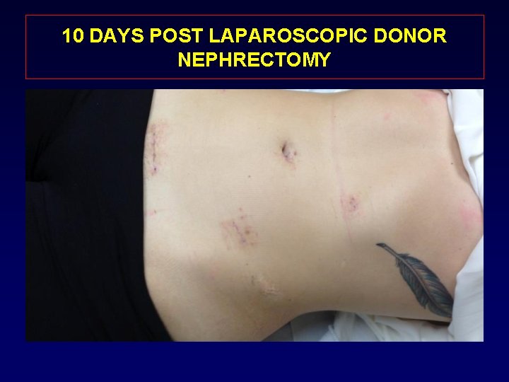 10 DAYS POST LAPAROSCOPIC DONOR NEPHRECTOMY 