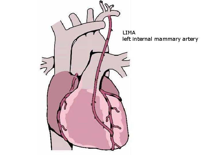 LIMA left internal mammary artery 