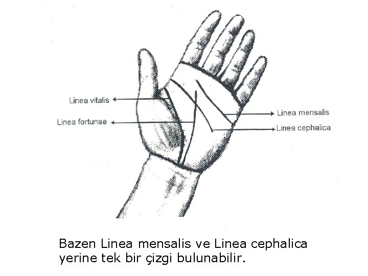 Bazen Linea mensalis ve Linea cephalica yerine tek bir çizgi bulunabilir. 