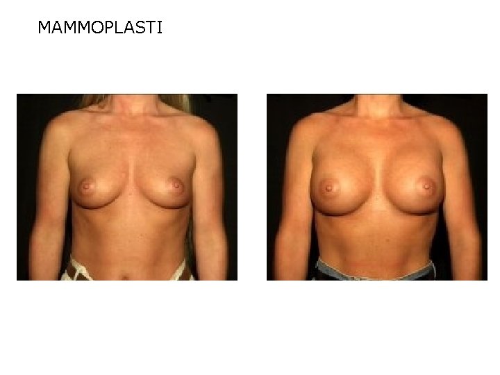 MAMMOPLASTI 