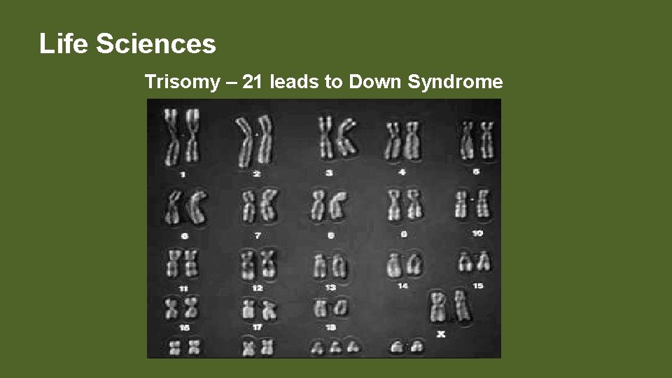 Life Sciences Trisomy – 21 leads to Down Syndrome 