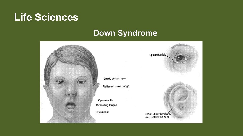 Life Sciences Down Syndrome 