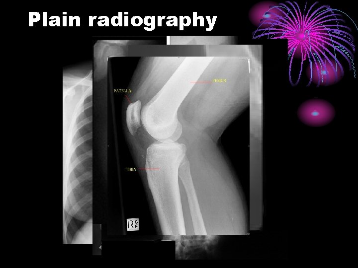 Plain radiography 