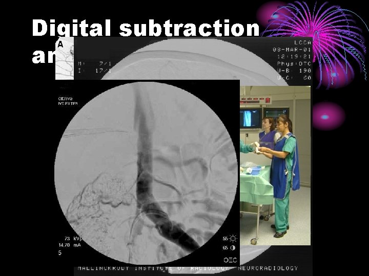 Digital subtraction angiography (DSA) 