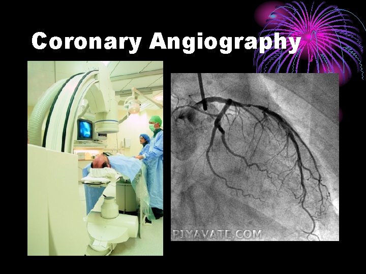 Coronary Angiography 