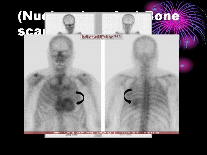 (Nuclear imaging) Bone scans 