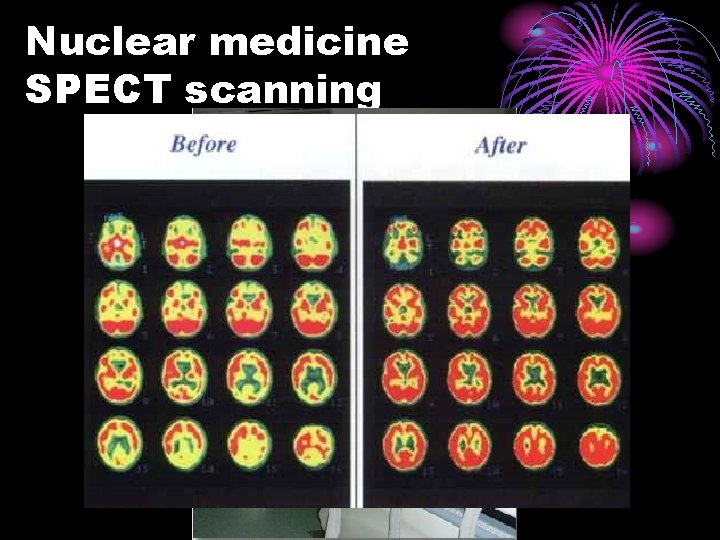 Nuclear medicine SPECT scanning 