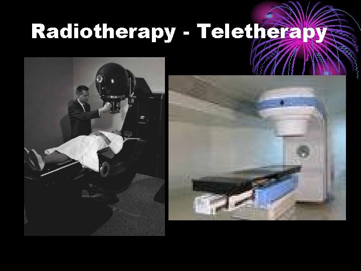 Radiotherapy - Teletherapy 