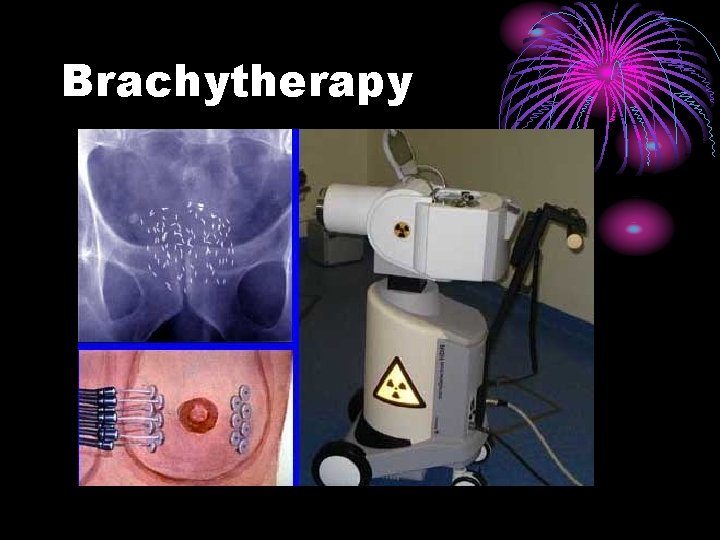 Brachytherapy 