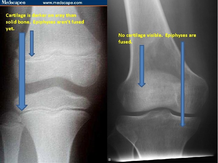 Cartilage is darker on xray than solid bone. Epiphyses aren’t fused yet. No cartilage