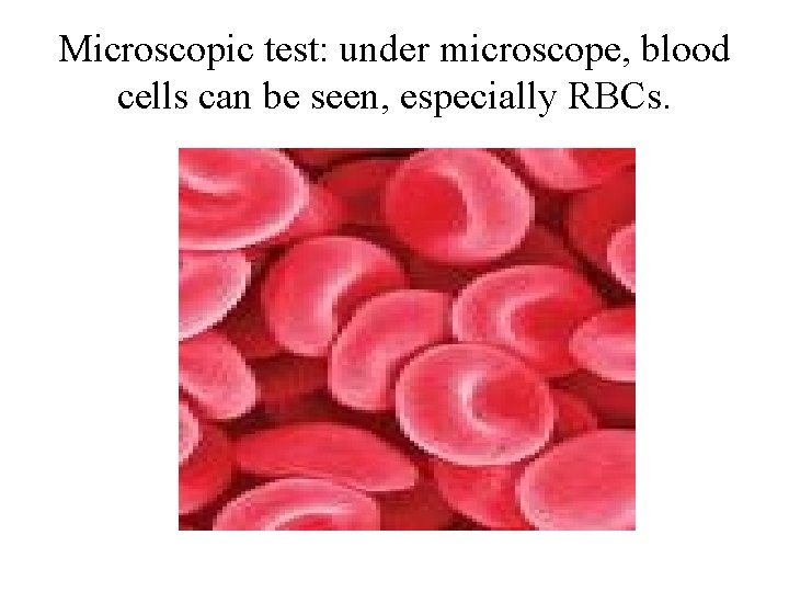 Microscopic test: under microscope, blood cells can be seen, especially RBCs. 