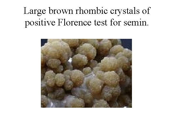 Large brown rhombic crystals of positive Florence test for semin. 
