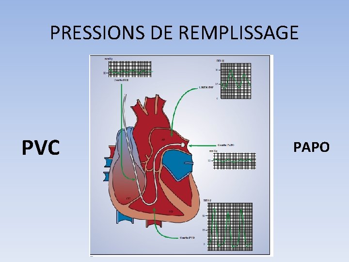 PRESSIONS DE REMPLISSAGE PVC PAPO 