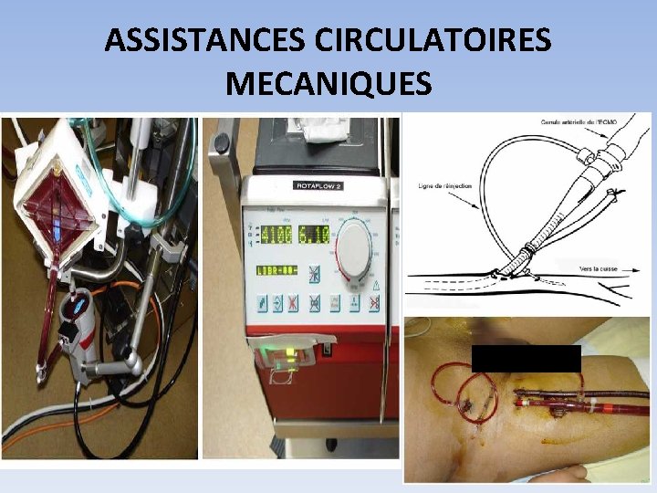 ASSISTANCES CIRCULATOIRES MECANIQUES , , 