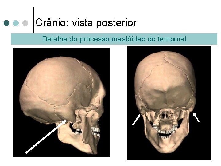 Crânio: vista posterior Detalhe do processo mastóideo do temporal 