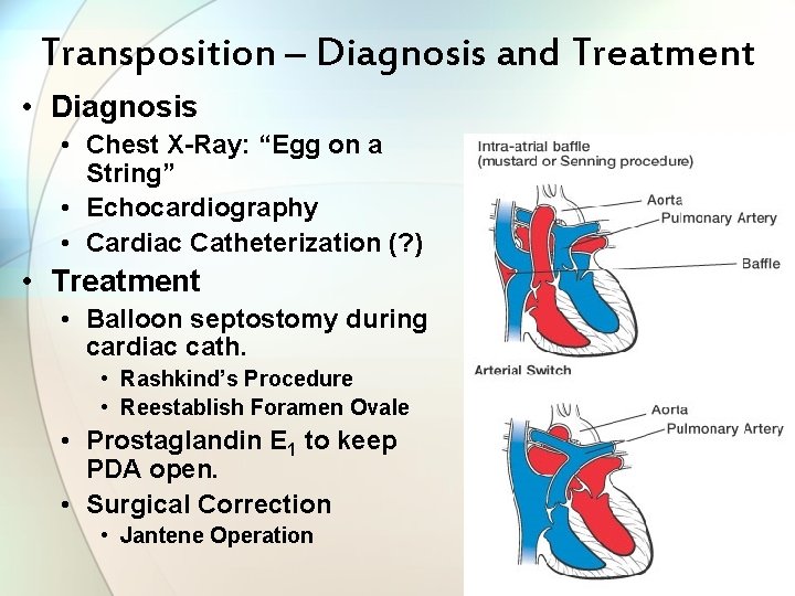 Transposition – Diagnosis and Treatment • Diagnosis • Chest X-Ray: “Egg on a String”