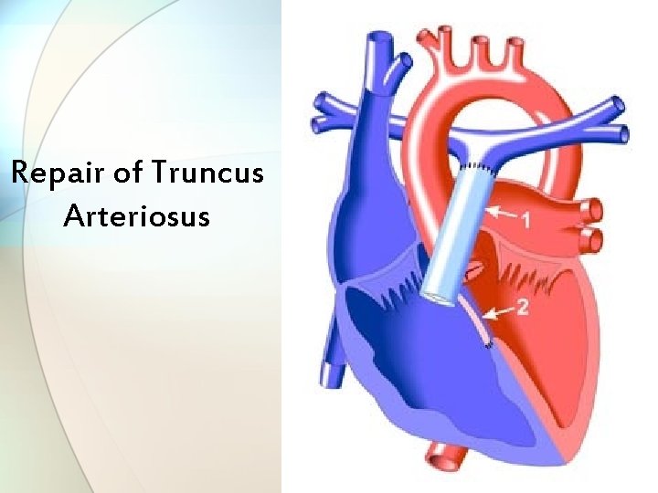 Repair of Truncus Arteriosus 