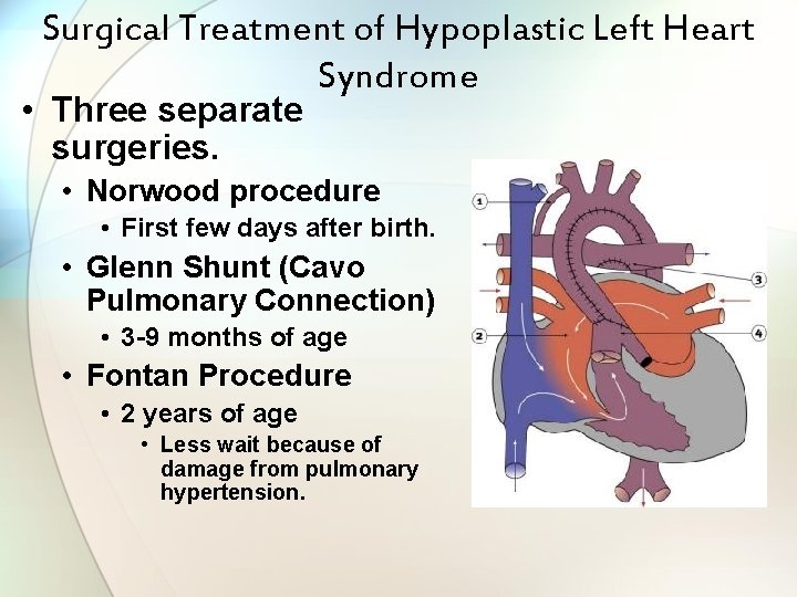 Surgical Treatment of Hypoplastic Left Heart Syndrome • Three separate surgeries. • Norwood procedure