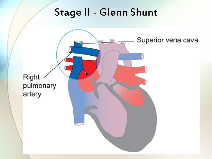 Stage II - Glenn Shunt 