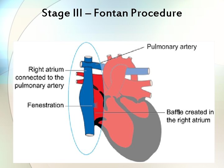 Stage III – Fontan Procedure 