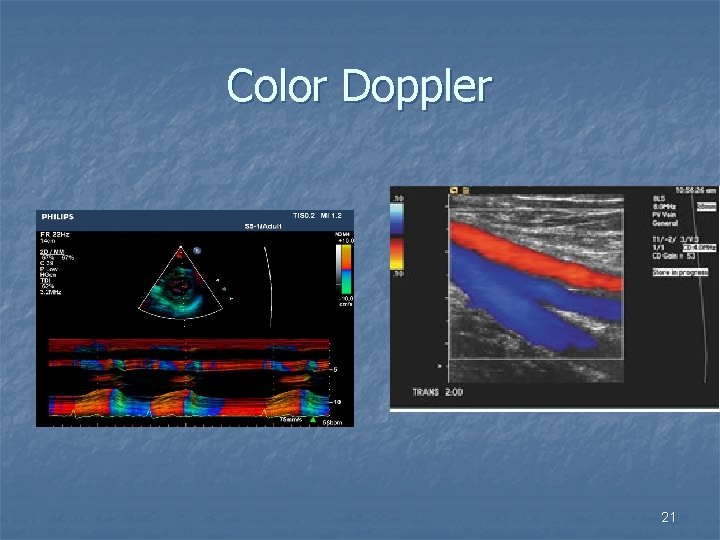Color Doppler 21 