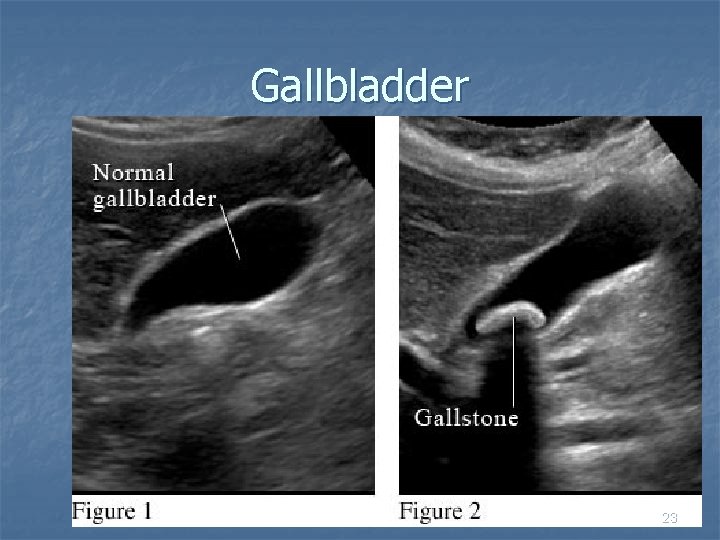 Gallbladder 23 