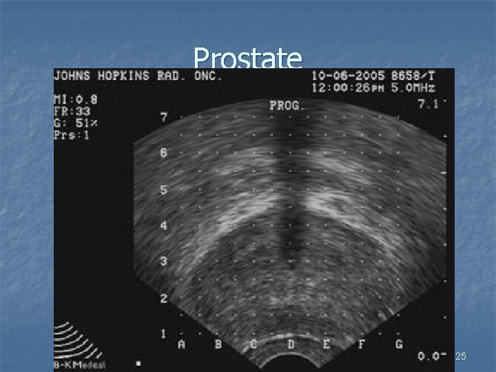 Prostate 25 