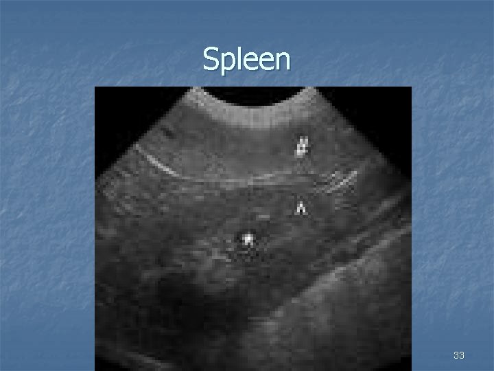 Spleen 33 
