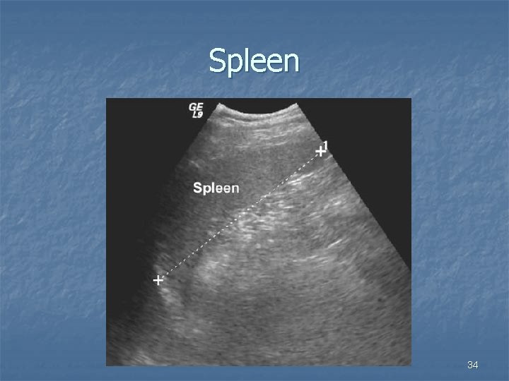 Spleen 34 