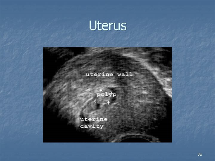 Uterus 36 