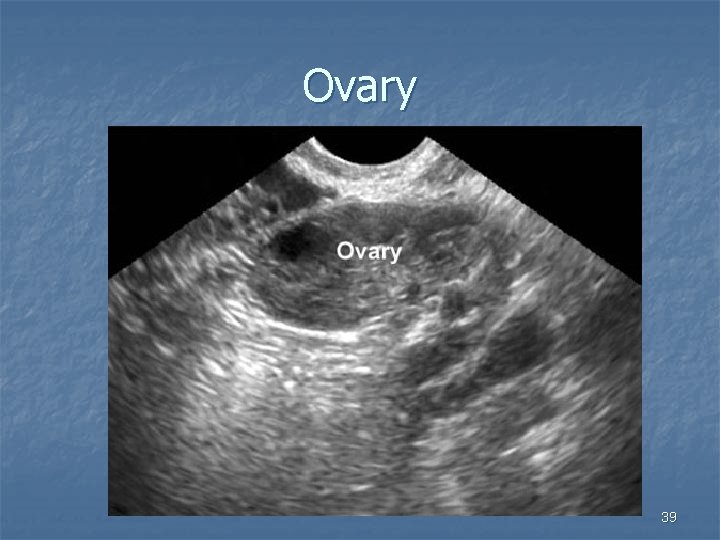 Ovary 39 