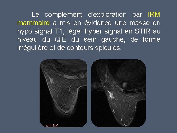 Le complément d'exploration par IRM mammaire a mis en évidence une masse en hypo