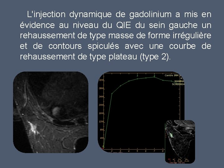 L'injection dynamique de gadolinium a mis en évidence au niveau du QIE du sein