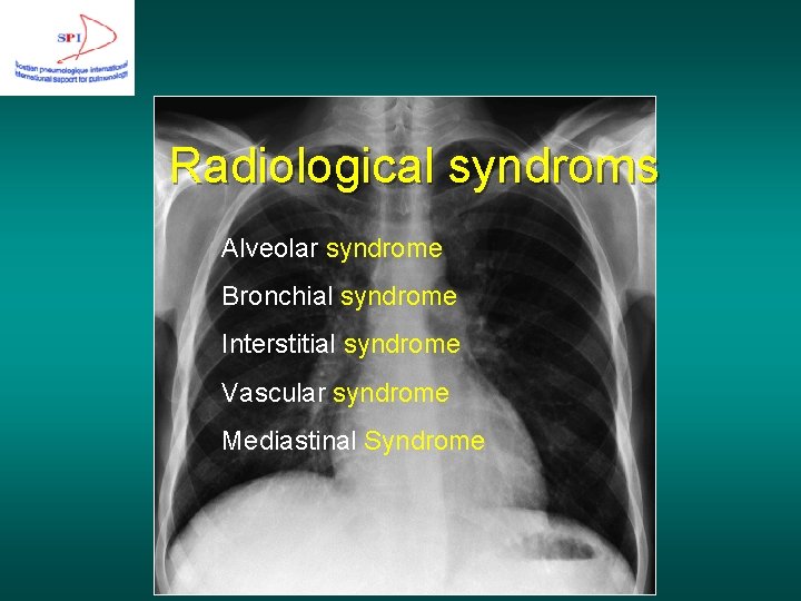Radiological syndroms Alveolar syndrome Bronchial syndrome Interstitial syndrome Vascular syndrome Mediastinal Syndrome 