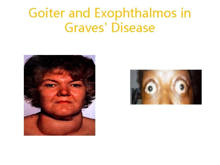 Goiter and Exophthalmos in Graves' Disease 