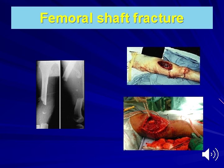 Femoral shaft fracture 