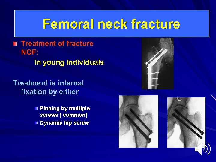 Femoral neck fracture Treatment of fracture NOF: in young individuals Treatment is internal fixation