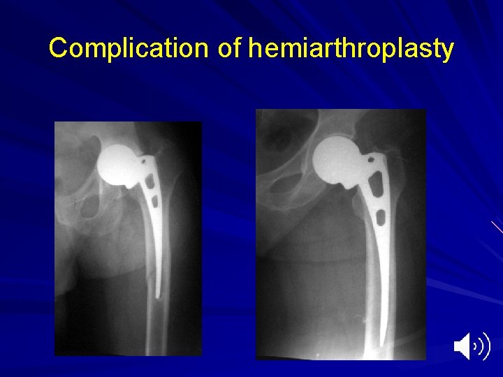 Complication of hemiarthroplasty 