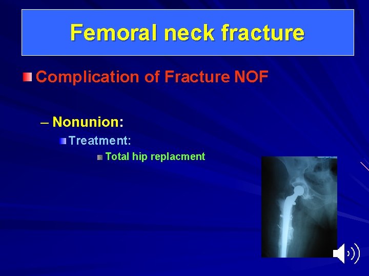 Femoral neck fracture Complication of Fracture NOF – Nonunion: Treatment: Total hip replacment 