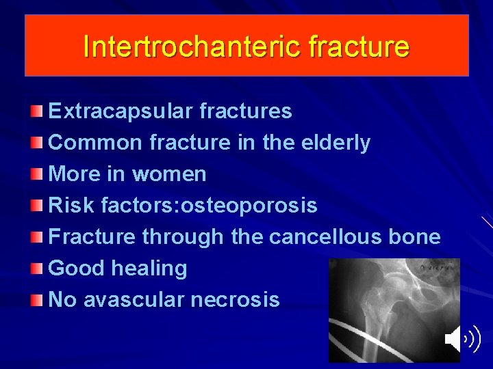 Intertrochanteric fracture Extracapsular fractures Common fracture in the elderly More in women Risk factors:
