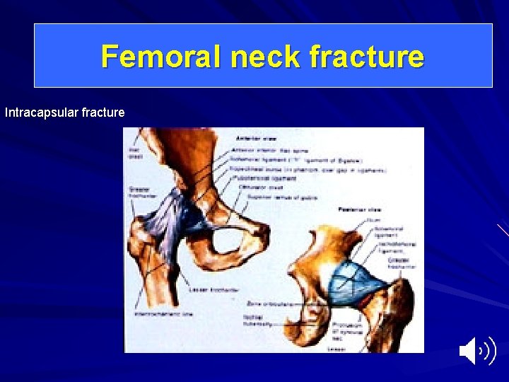 Femoral neck fracture Intracapsular fracture 