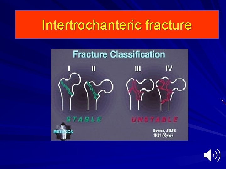 Intertrochanteric fracture 