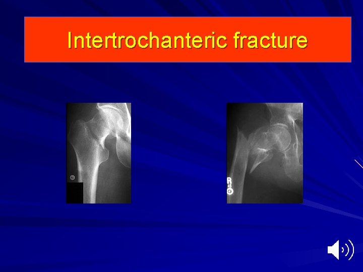 Intertrochanteric fracture 