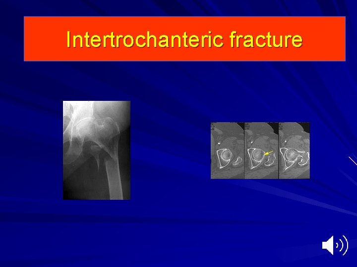 Intertrochanteric fracture 