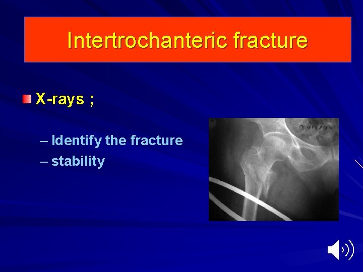 Intertrochanteric fracture X-rays ; – Identify the fracture – stability 