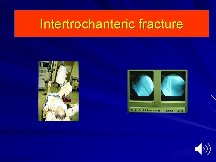 Intertrochanteric fracture 