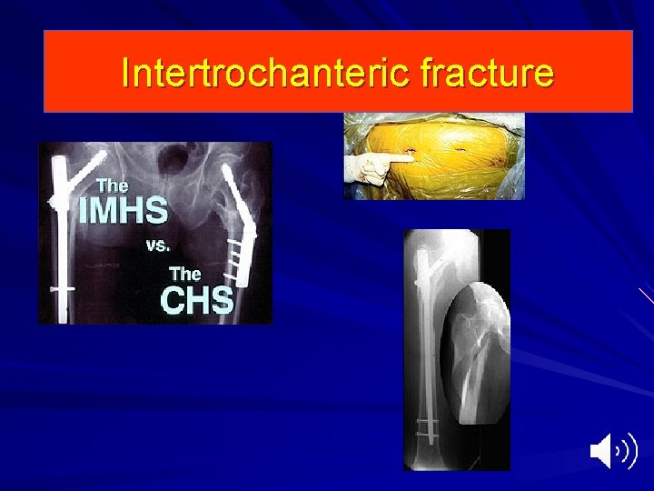 Intertrochanteric fracture 